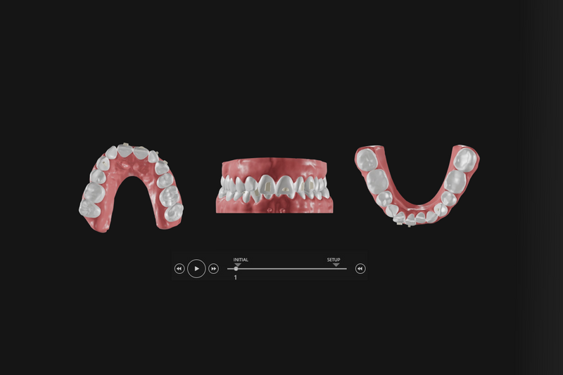 set-up numérique plan de traitement Orthogem traitement d'alignement dentaire ODF laboratoire spécialisé en orthodontie prothèse ODF
