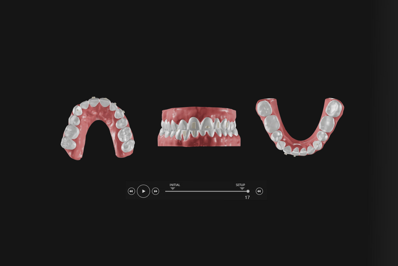 Set-up numérique plan de traitement alignement dentaire Orthogem meilleur laboratoire ODF et orthodontie France