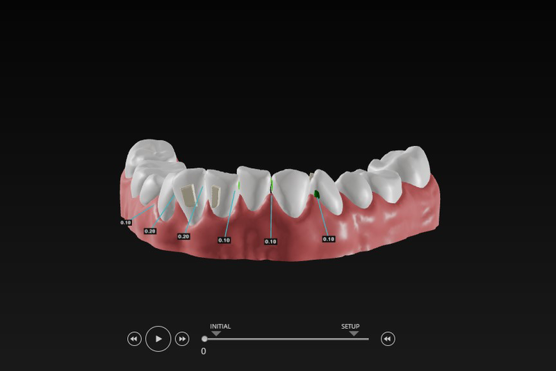 Stripping taquet attachment traitement d'alignement dentaire Orthogem meilleur laboratoire ODF et prothèse orthodontique en France